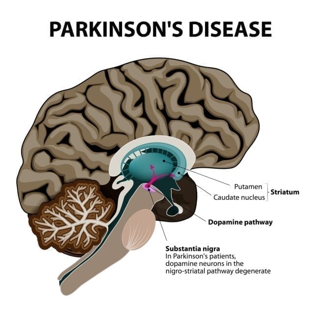 Substance noire et Parkinson